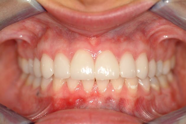 After treatment
