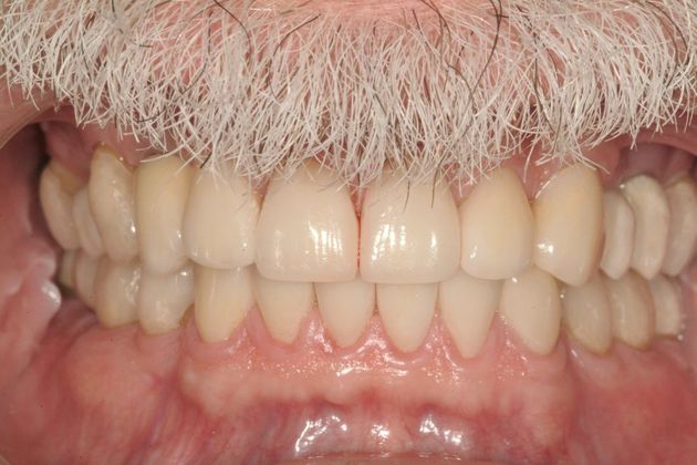 Full Mouth Reconstruction Case 1 - After