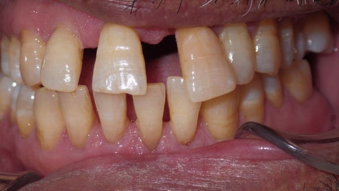 Bridges Case 1 - Before