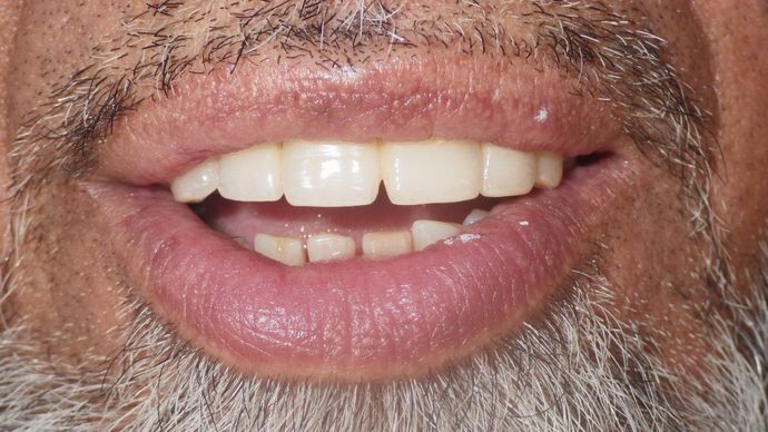 Bridges Case 1 - After