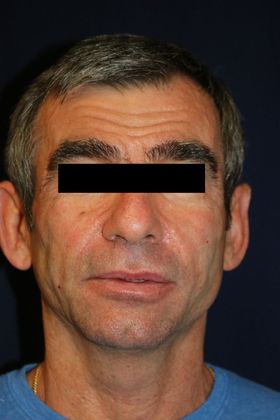 Cosmetic Injectables & Fillers*: Case 24 Cheek & Temple Filler - After