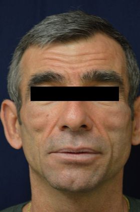 Cosmetic Injectables & Fillers*: Case 24 Cheek & Temple Filler - Before