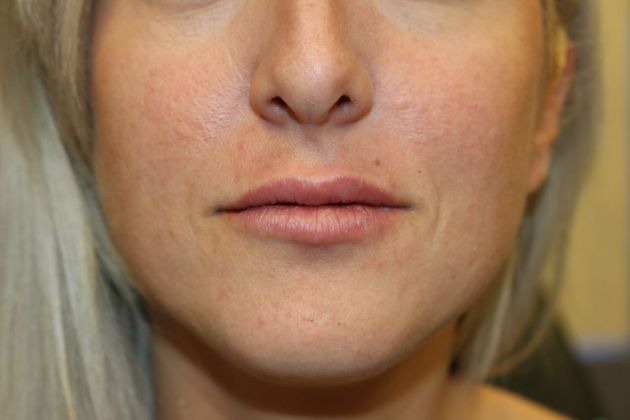 Cosmetic Injectables & Fillers*: Case 17 Lip Filler - After