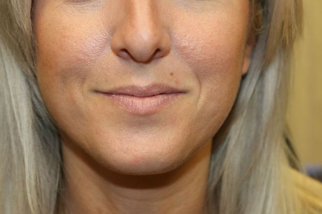 Cosmetic Injectables & Fillers*: Case 17 Lip Filler - Before