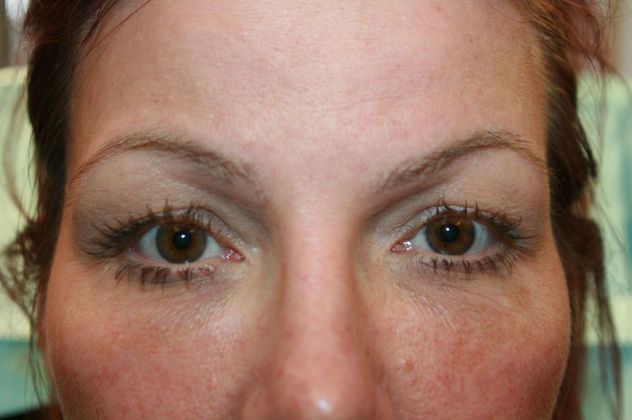 Cosmetic Injectables & Fillers*: Case 32 Undereye Filler - After