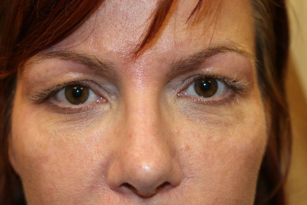 Cosmetic Injectables & Fillers*: Case 32 Undereye Filler - Before