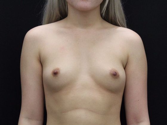 Breast Augmentation: Case 66 - Before
