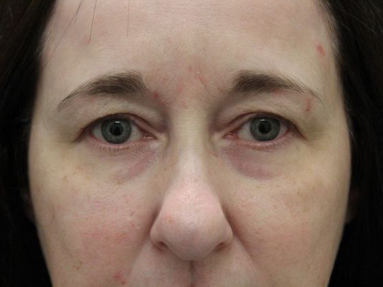 Eyelid Surgery: Case 6 - Before