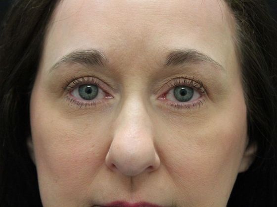 Eyelid Surgery: Case 6 - After