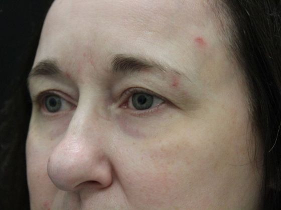 Eyelid Surgery: Case 6 - Before