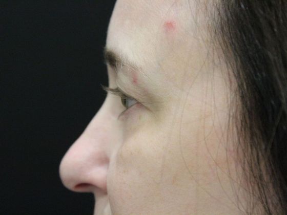 Eyelid Surgery: Case 6 - Before