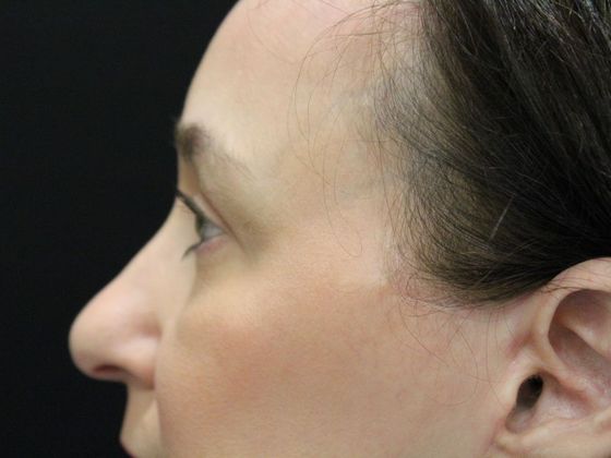 Eyelid Surgery: Case 6 - After