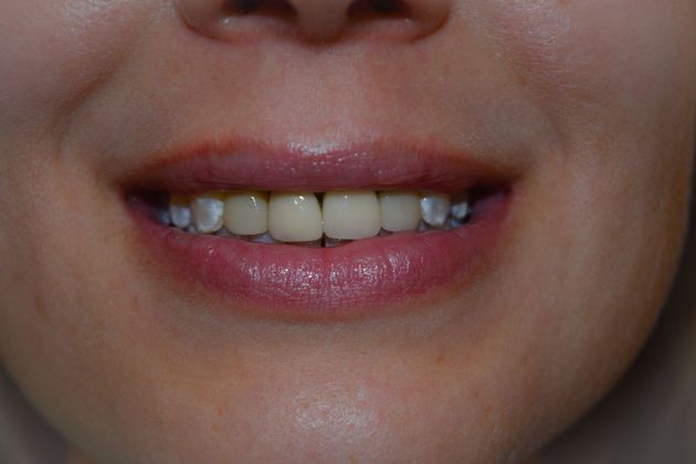 Smile Makeover 8 VENEERS (case 4) - Before