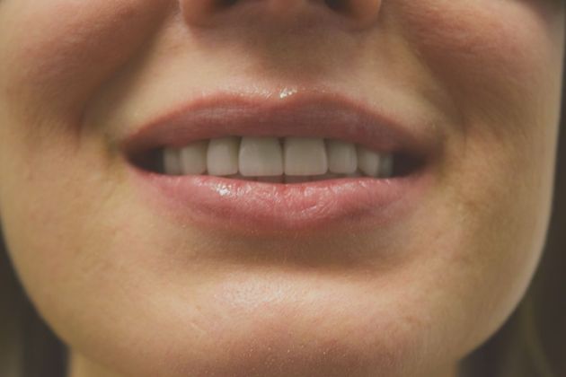 Smile Makeover 8 VENEERS (case 4) - After