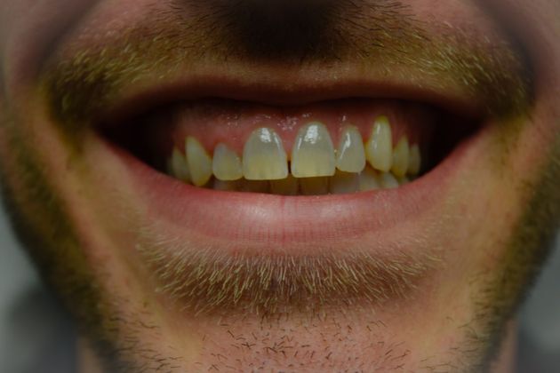 Man with stained and gapped smile