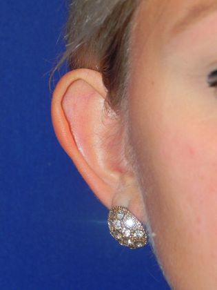 Ear Correction / Otoplasty Case 2 (22395) - Before