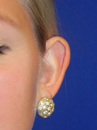 Ear Correction / Otoplasty: Case 2 (22395) - Before