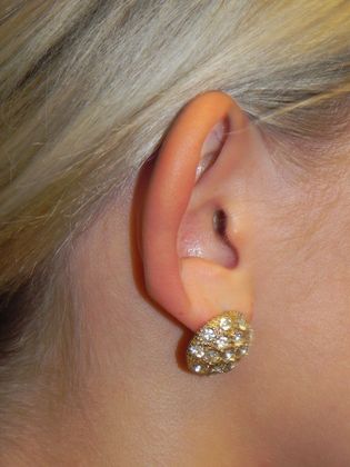 Ear Correction / Otoplasty: Case 2 (22395) - Before