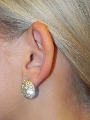 Ear Correction / Otoplasty: Case 2 (22395) - Before