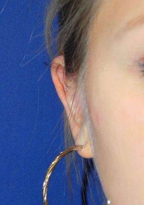 Ear Correction / Otoplasty Case 2 (22395) - After