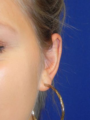 Ear Correction / Otoplasty: Case 2 (22395) - After
