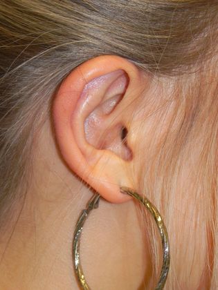 Ear Correction / Otoplasty: Case 2 (22395) - After