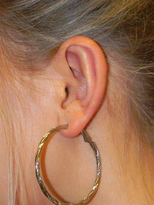 Ear Correction / Otoplasty: Case 2 (22395) - After