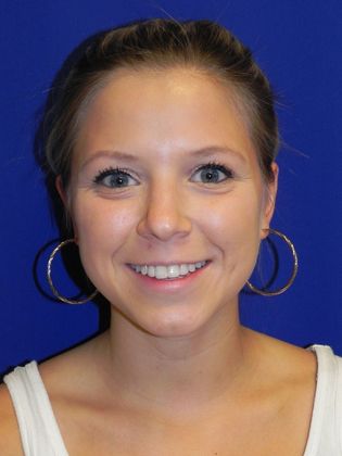 Ear Correction / Otoplasty: Case 2 (22395) - Before