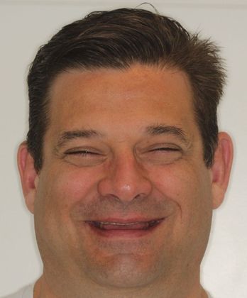 Full Mouth Rehabilitation: Extreme Tooth Wear - Before