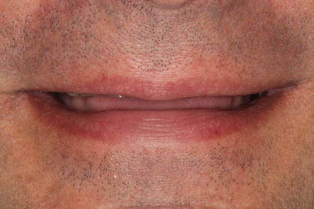 Full Mouth Rehabilitation: Extreme Tooth Wear - Before