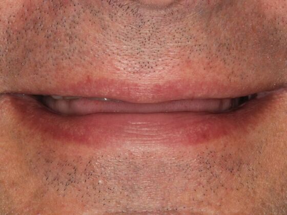 Full Mouth Rehabilitation Case 4 - Before