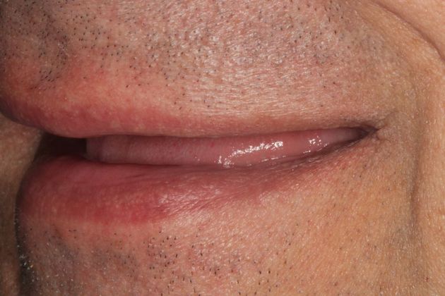 Full Mouth Rehabilitation: Extreme Tooth Wear - Before