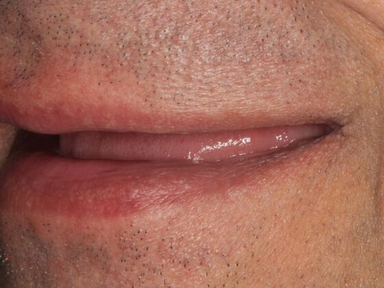 Full Mouth Rehabilitation: Case 4 - Before