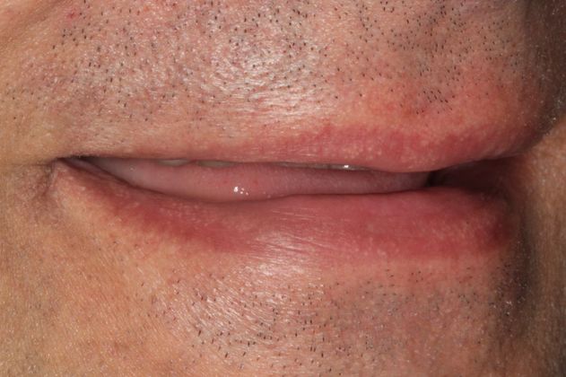 Full Mouth Rehabilitation: Extreme Tooth Wear - Before