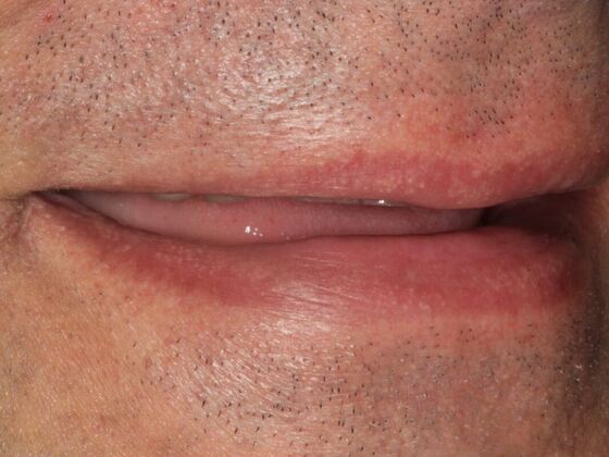 Full Mouth Rehabilitation: Case 4 - Before