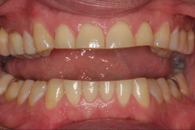 Full Mouth Rehabilitation: Extreme Tooth Wear - Before