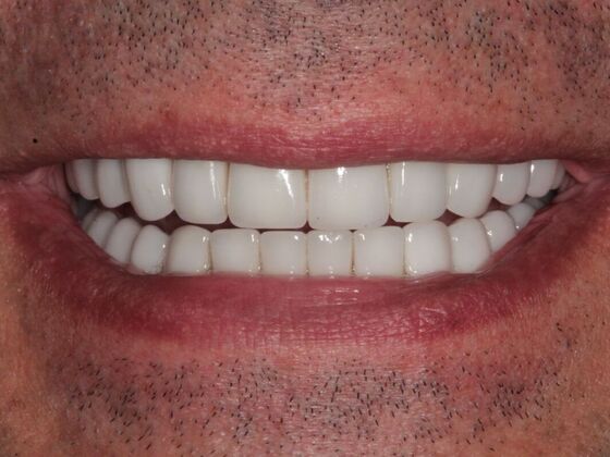 Full Mouth Rehabilitation Case 4 - After