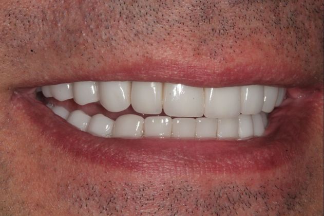 Full Mouth Rehabilitation: Extreme Tooth Wear - After