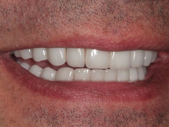 Full Mouth Rehabilitation: Case 4 - After