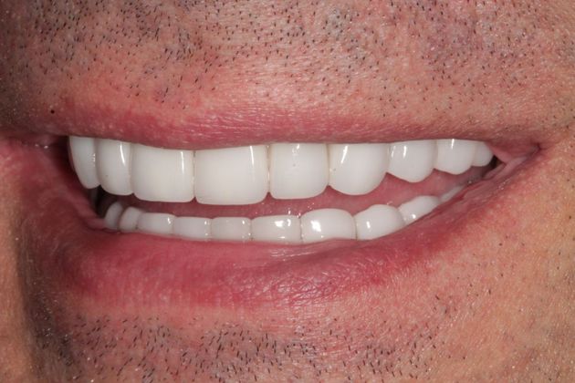 Full Mouth Rehabilitation: Extreme Tooth Wear - After