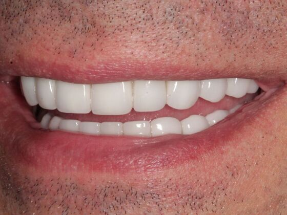 Full Mouth Rehabilitation: Case 4 - After