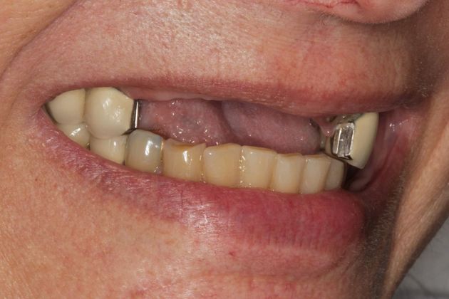 Front Teeth Implants and Full Mouth Reconstruction - Dental Implants ...