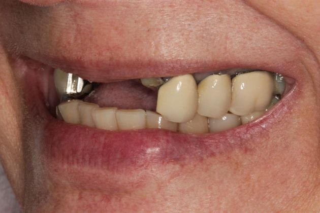 Dental Implants: Upper Front Teeth Implants and Full Mouth Reconstruction - Before