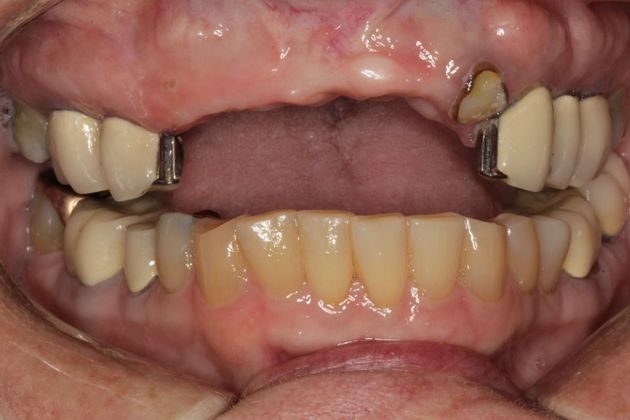 Dental Implants: Upper Front Teeth Implants and Full Mouth Reconstruction - Before