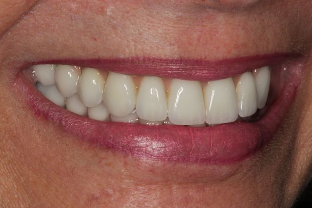 Dental Implants: Upper Front Teeth Implants and Full Mouth Reconstruction - After