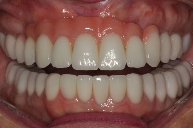 Dental Implants: Upper Front Teeth Implants and Full Mouth Reconstruction - After