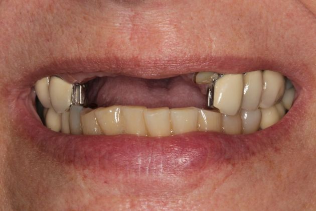 Dental Implants Upper Front Teeth Implants and Full Mouth Reconstruction - Before