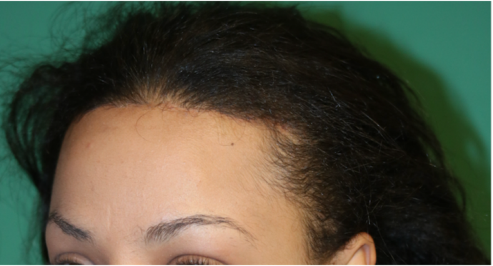Hairline Lowering Surgery: Case 7 - After