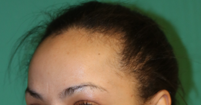 Hairline Lowering Surgery: Case 7 - Before