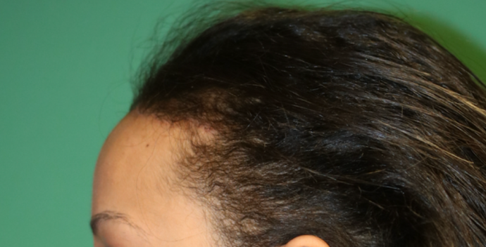 Hairline Lowering Surgery: Case 7 - After